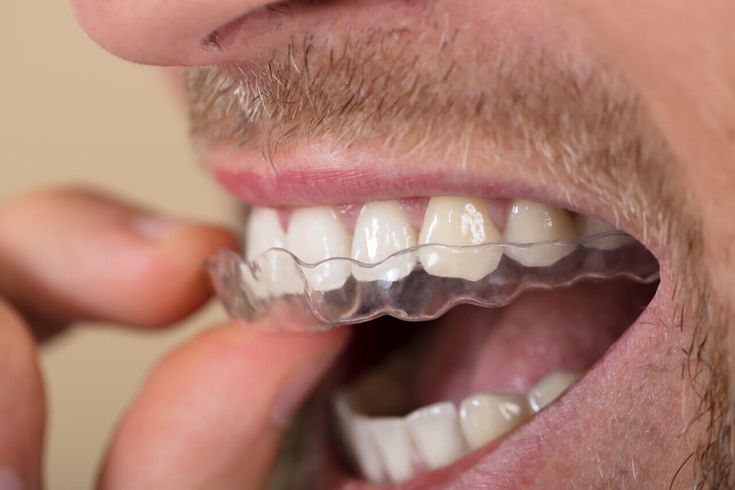 Fitting a clear protective mouth guard