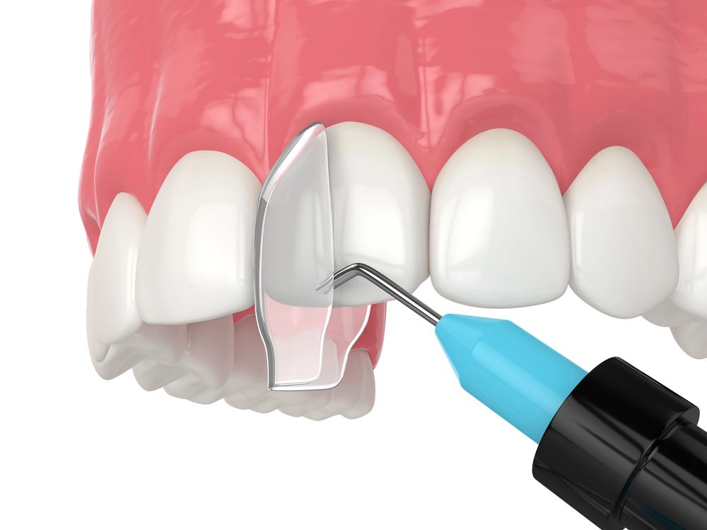 Dental bonding treatment illustration