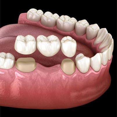 Dental bridge replacing missing teeth
