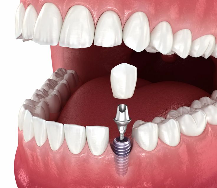 Dental implant and crown illustration
