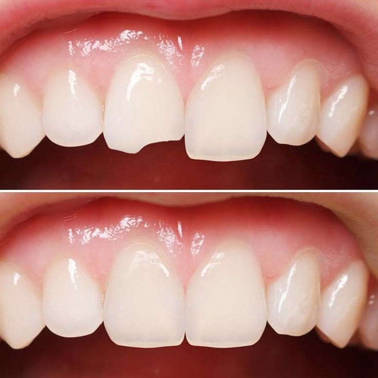 Tooth shape before and after reshaping