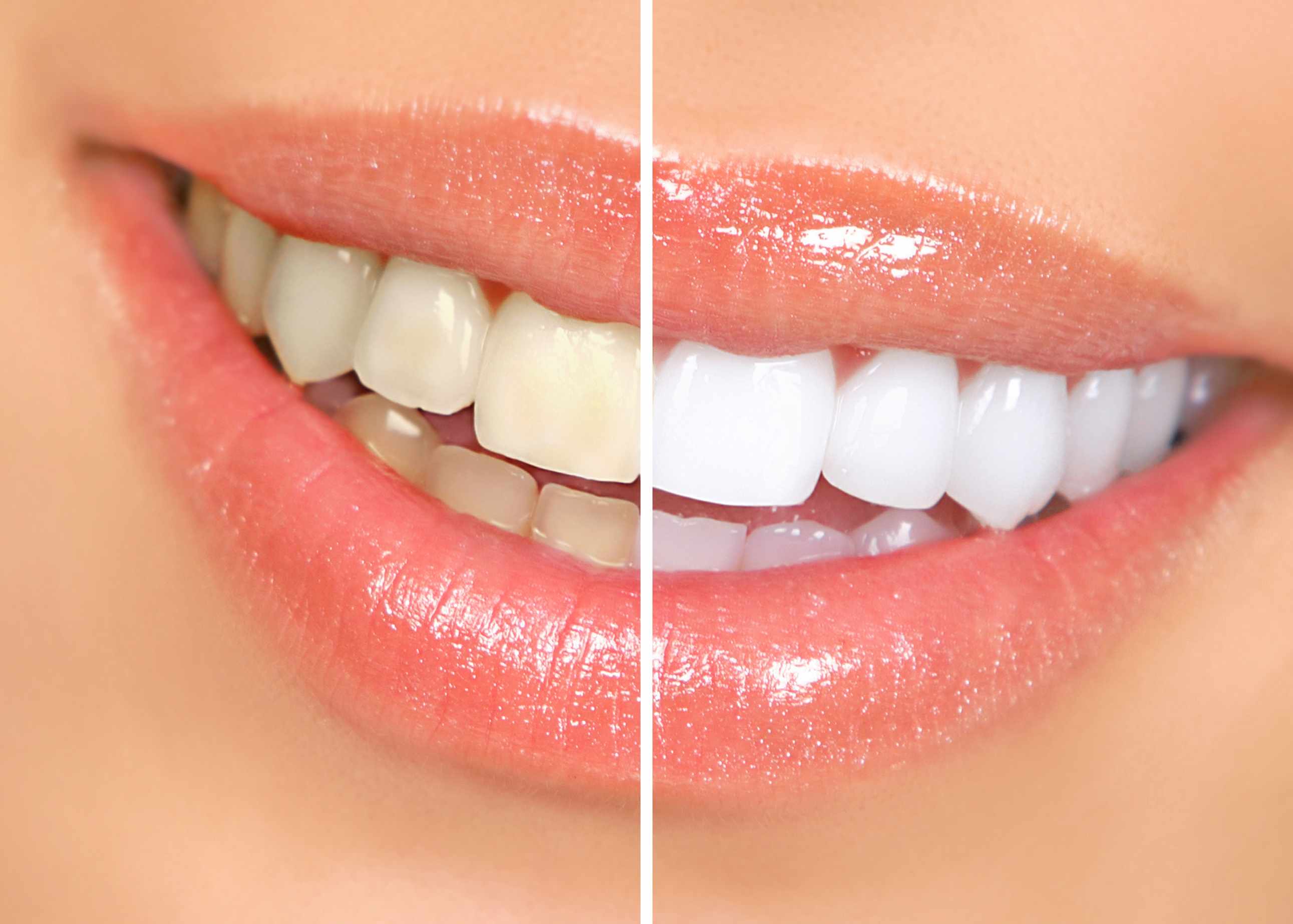 Teeth whitening before-and-after comparison